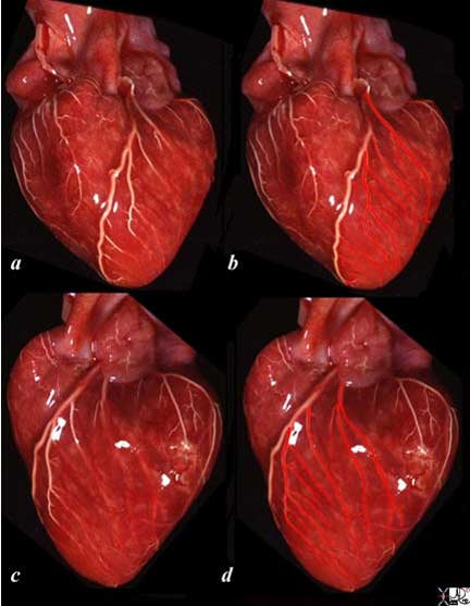 Coronary Arteries | Arteries