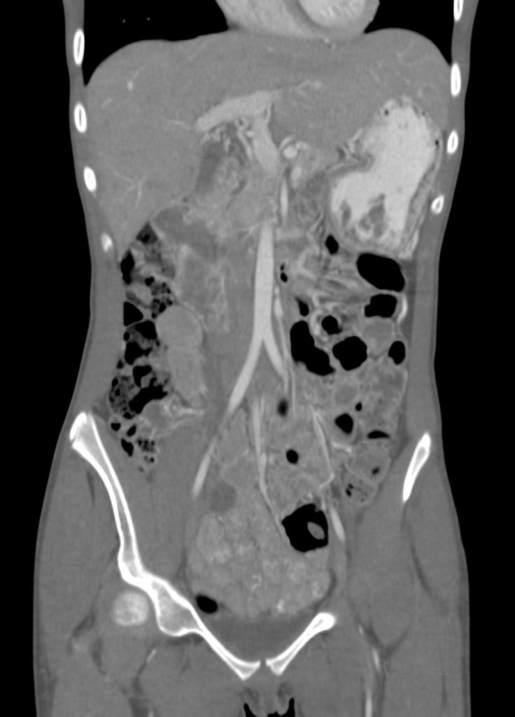 001A Polyarteritis Nodosa | Arteries